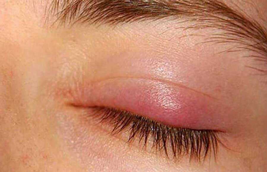 بهترین پماد چشمی برای گل مژه چیست؟