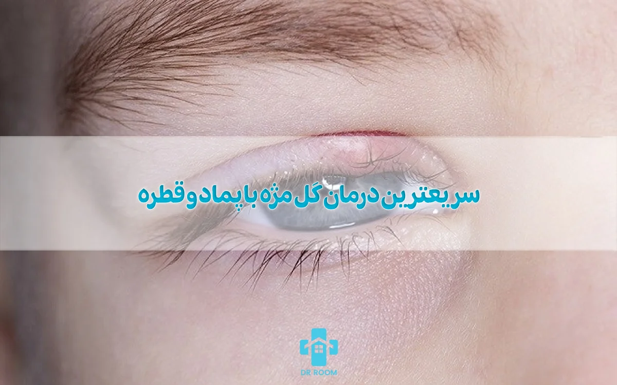 سریعترین درمان گل مژه